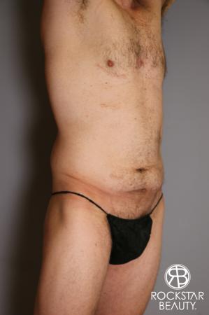 Tummy Tuck: Patient 11 - Before Image 2