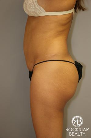 Liposuction: Patient 3 - Before and After Image 5