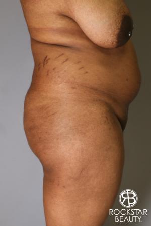 Brazilian Butt Lift: Patient 13 - Before Image 2