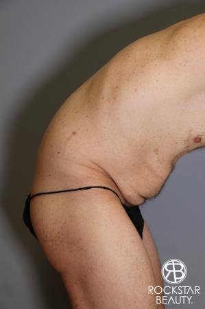 Tummy Tuck: Patient 11 - Before Image 3