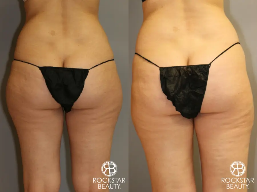 SmartLipo®: Patient 1 - Before and After 2