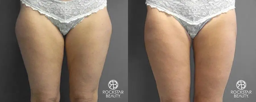 SmartLipo®: Patient 4 - Before and After 1