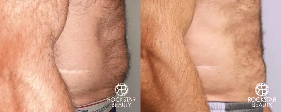 SmartLipo®: Patient 2 - Before and After 3