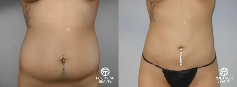 SmartLipo®: Patient 3 - Before and After 1