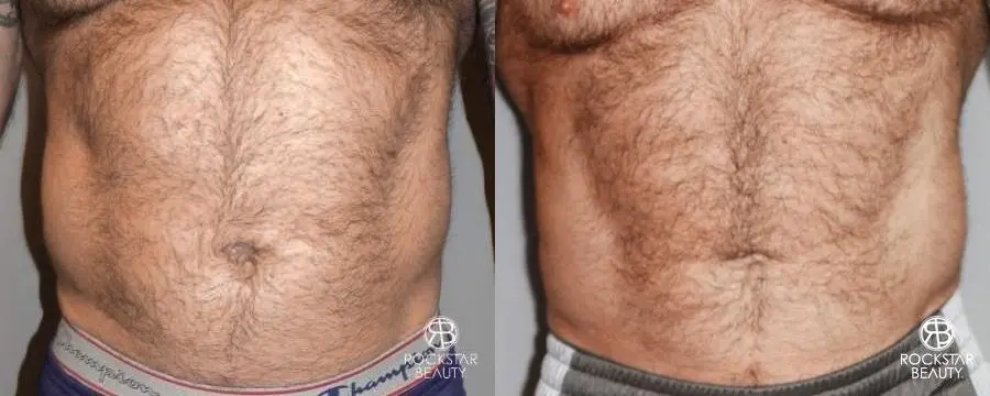 SmartLipo®: Patient 2 - Before and After 1