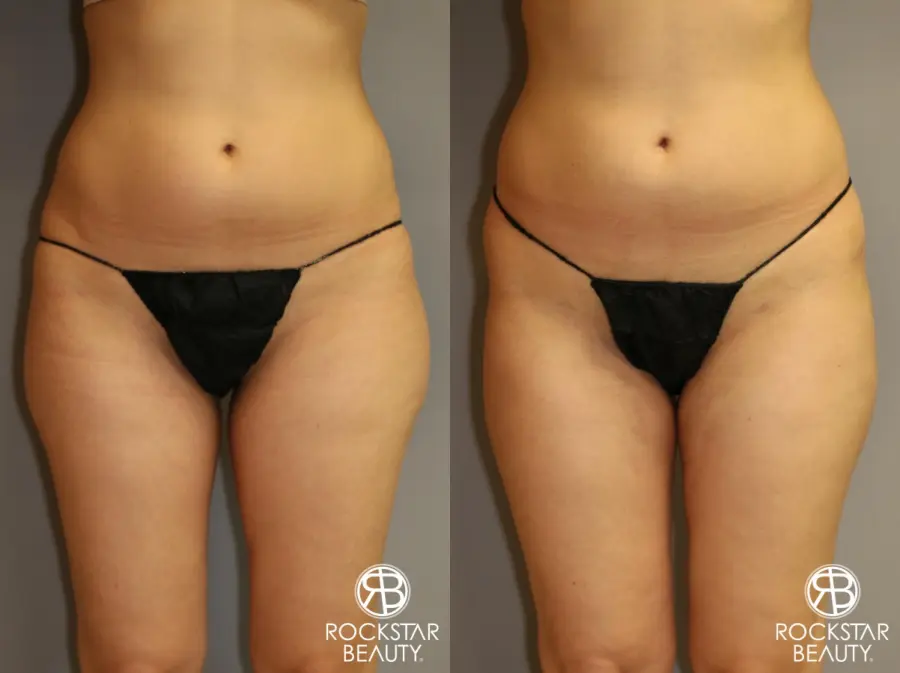 SmartLipo®: Patient 1 - Before and After 1