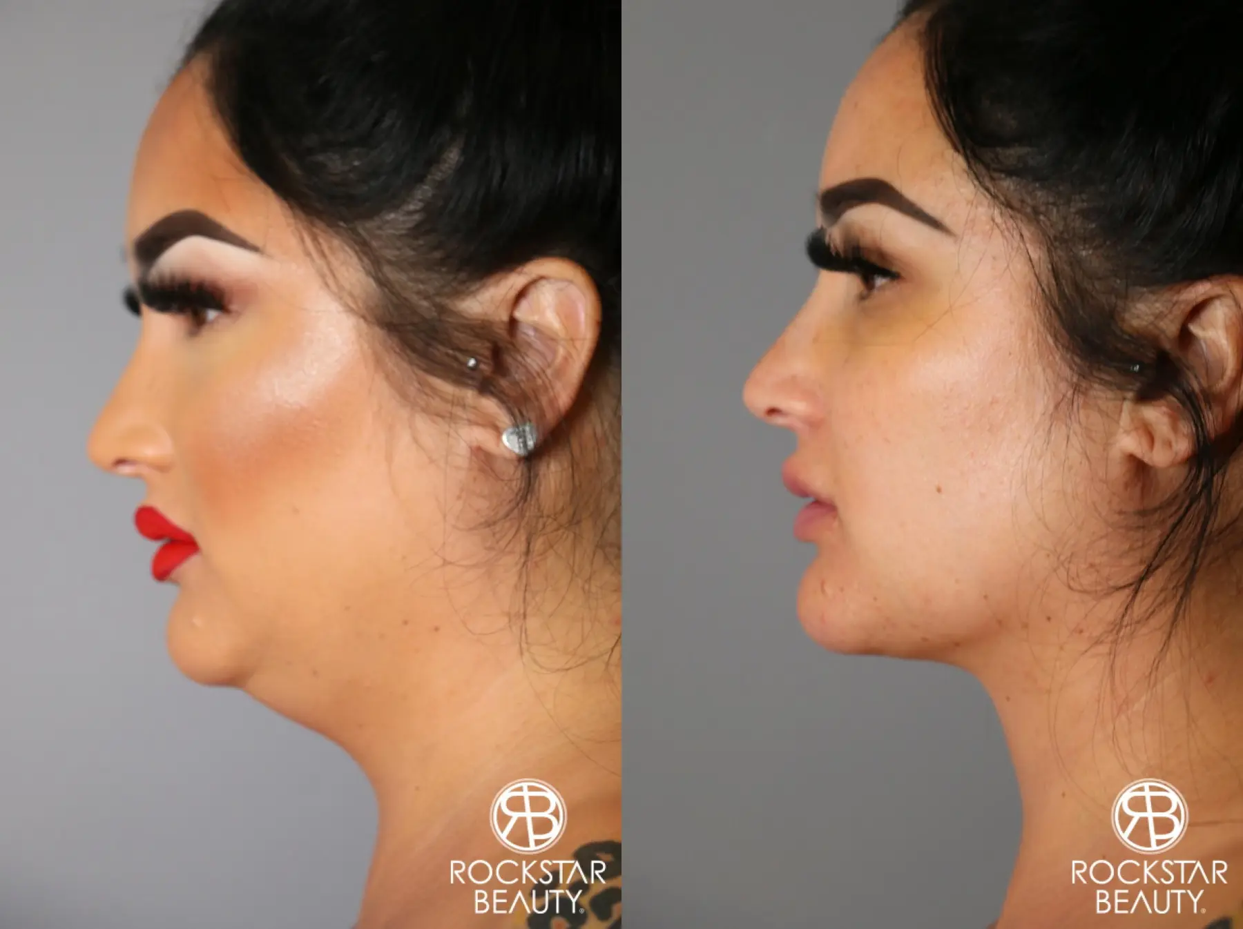 SmartLipo® Face And Neck: Patient 1 - Before and After  