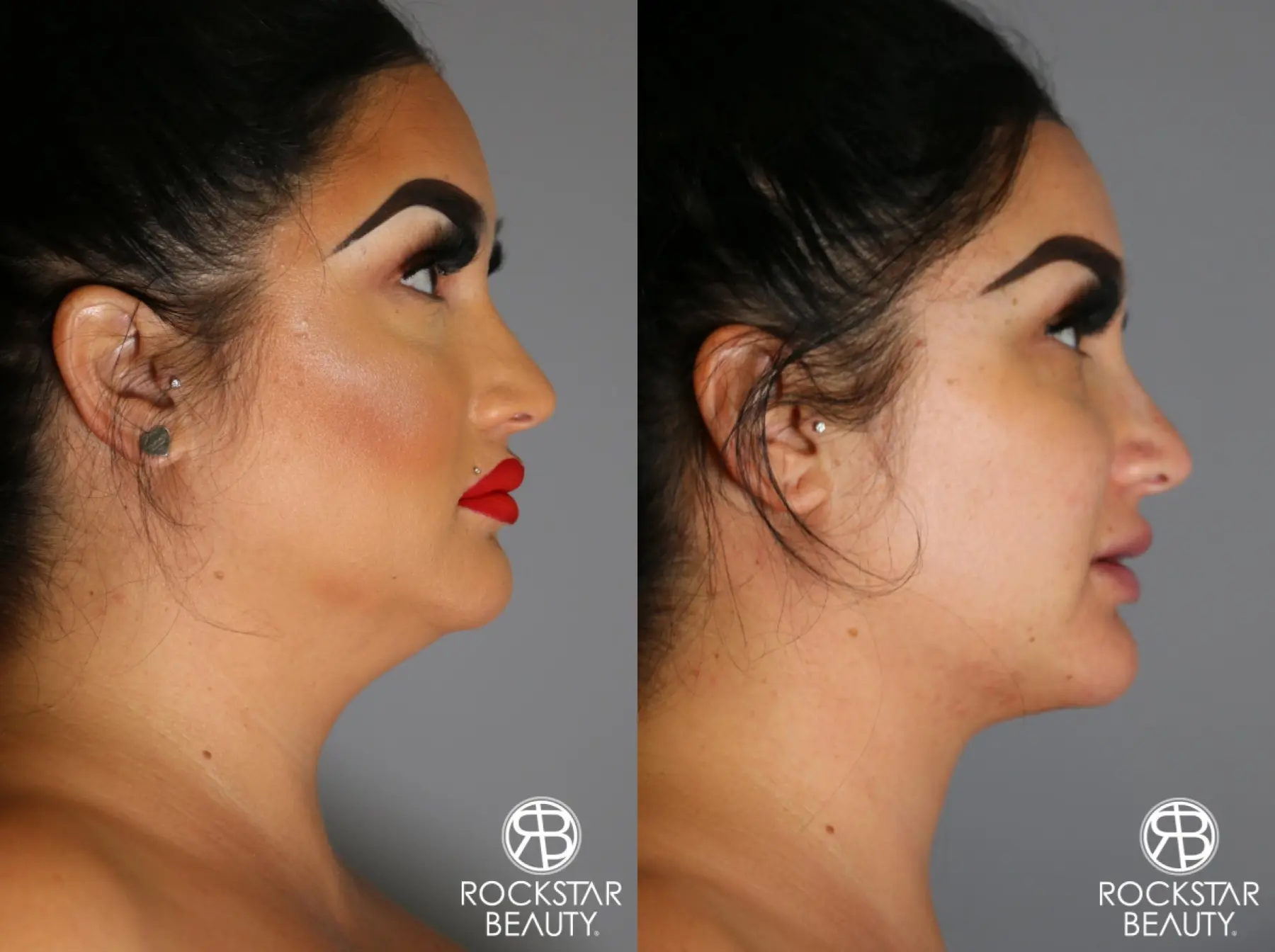 SmartLipo® Face And Neck: Patient 1 - Before and After 2