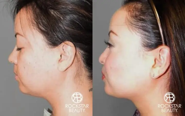 SmartLipo® Face And Neck: Patient 2 - Before and After  