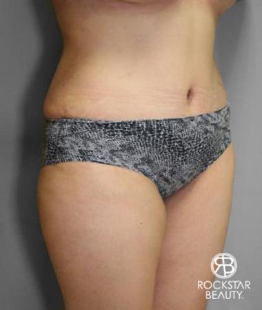 Tummy Tuck: Patient 10 - After 2