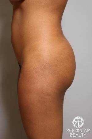 Brazilian Butt Lift: Patient 10 - Before Image 2