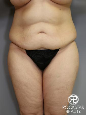 Tummy Tuck: Patient 4 - Before Image 1