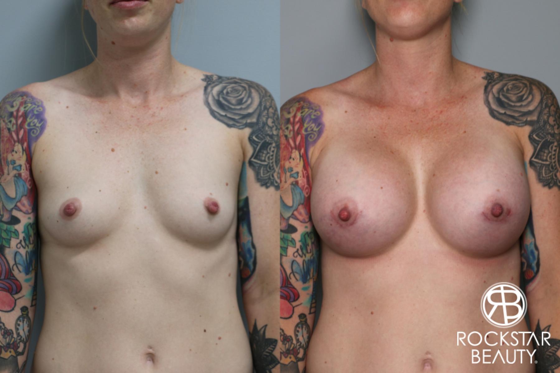 Breast Augmentation: Patient 31 - Before and After 1