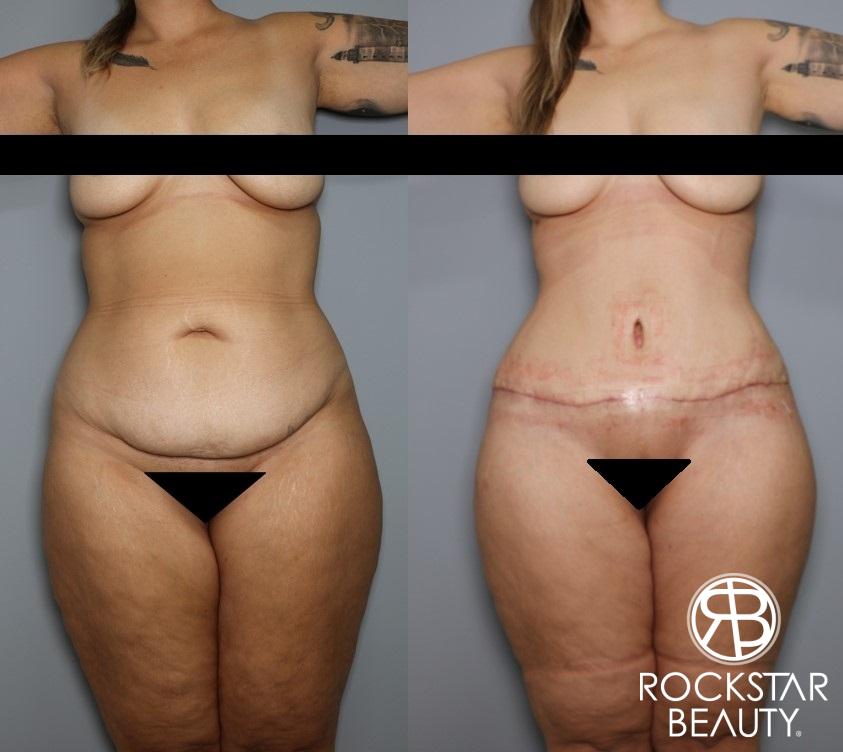 Tummy Tuck: Patient 26 - Before and After 1