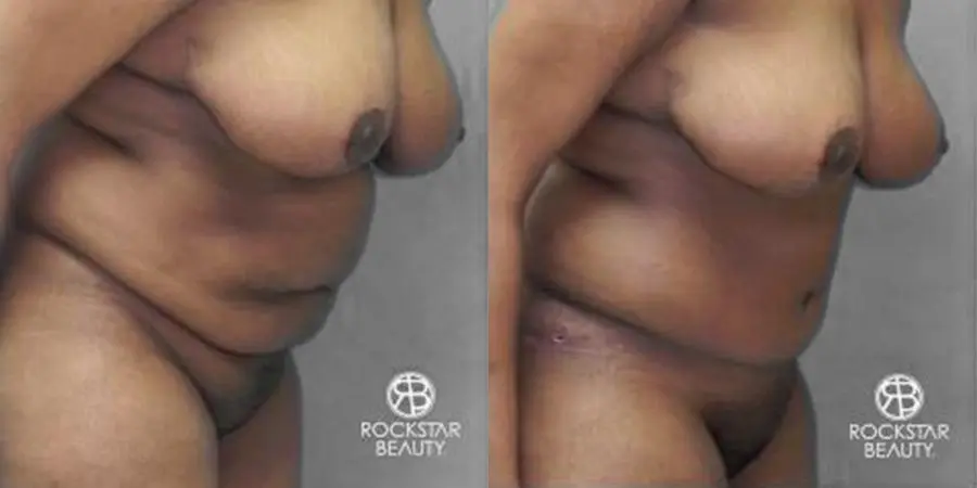 Tummy Tuck: Patient 9 - Before and After 3