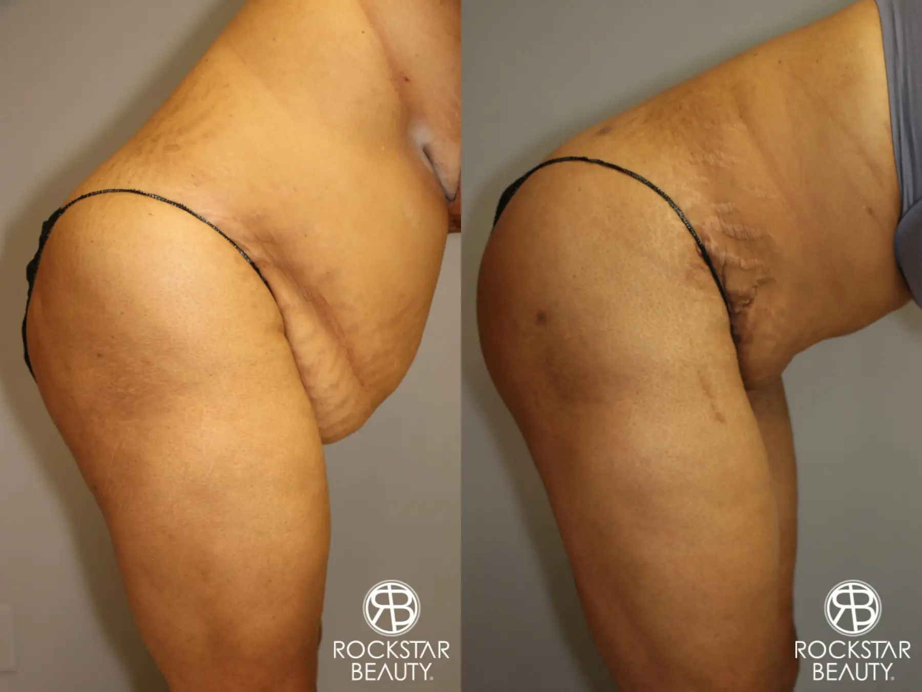 Tummy Tuck: Patient 3 - Before and After 4