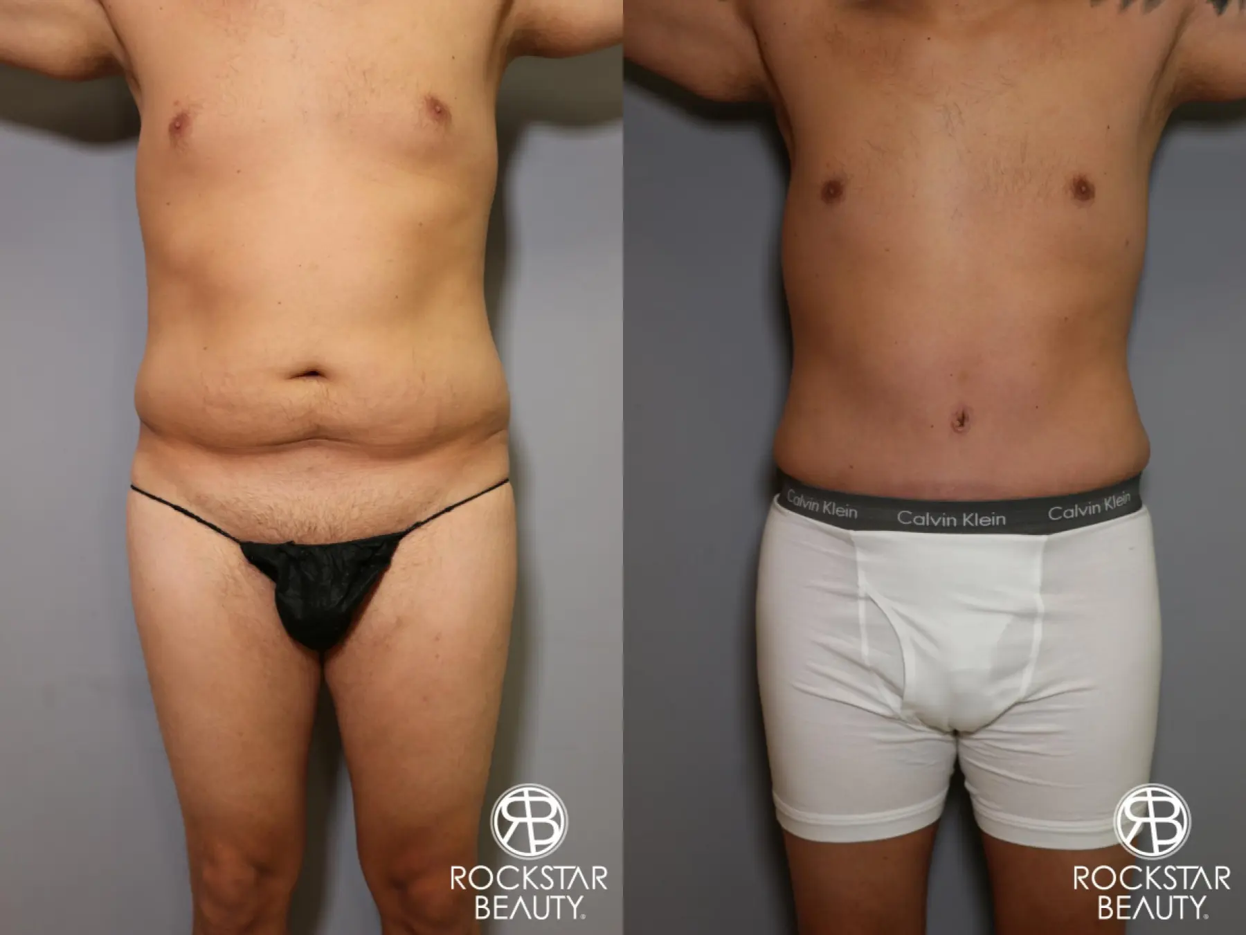 Tummy Tuck: Patient 5 - Before and After 2