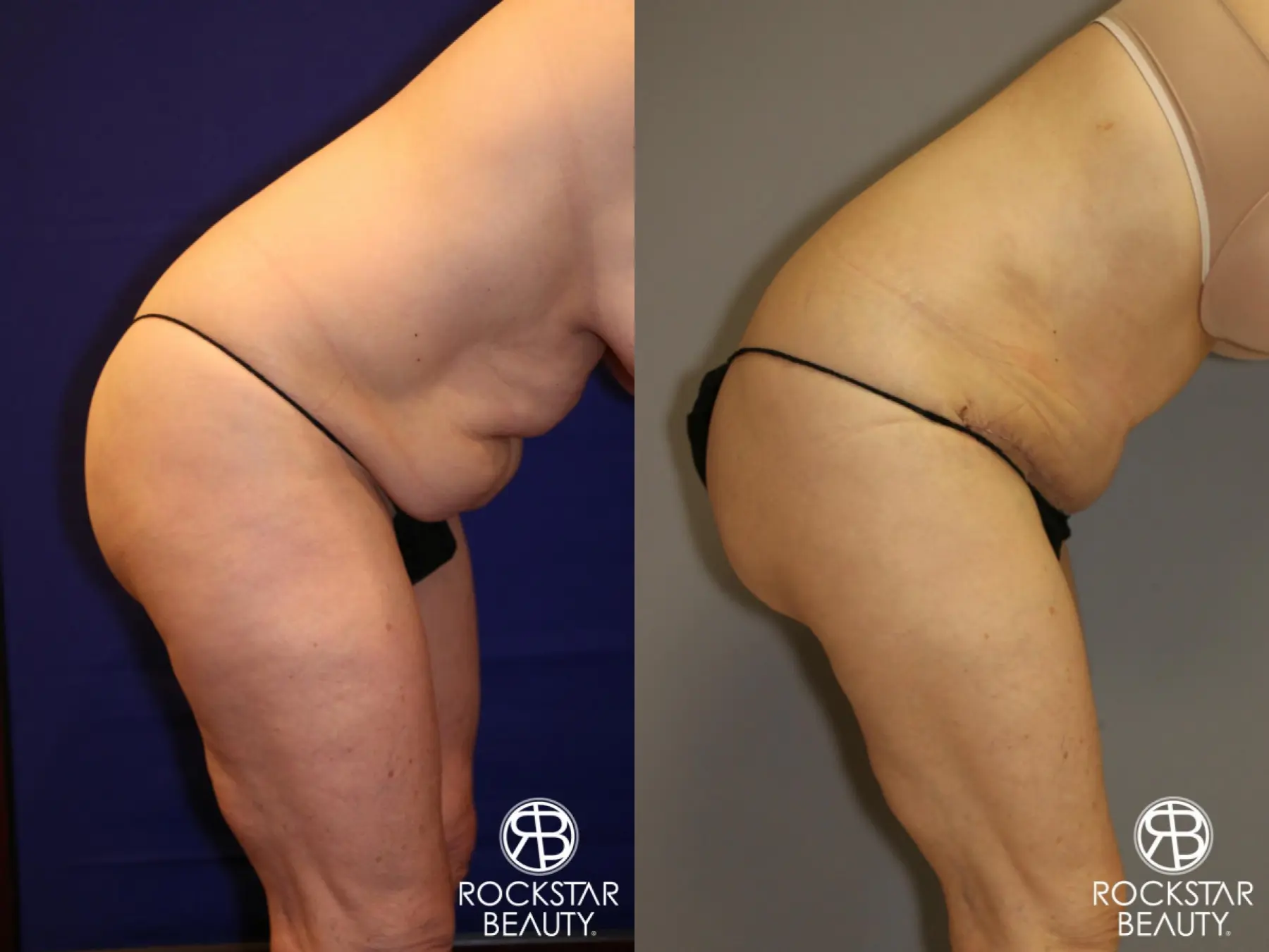 Tummy Tuck: Patient 12 - Before and After 5