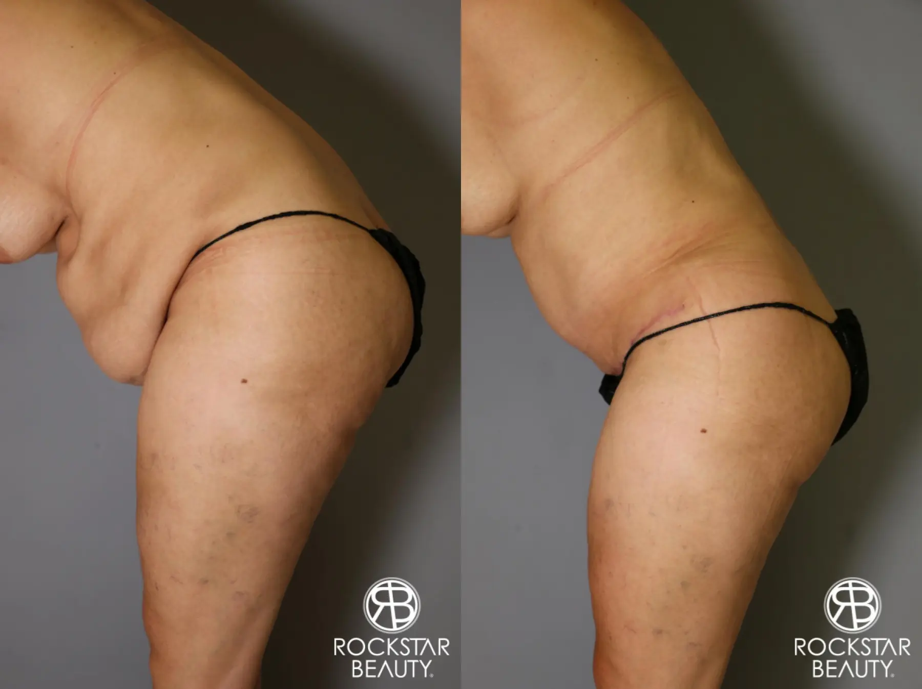 Tummy Tuck: Patient 13 - Before and After 4