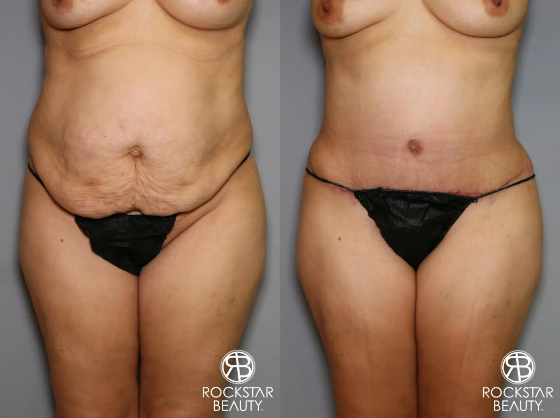 Tummy Tuck: Patient 13 - Before and After 1