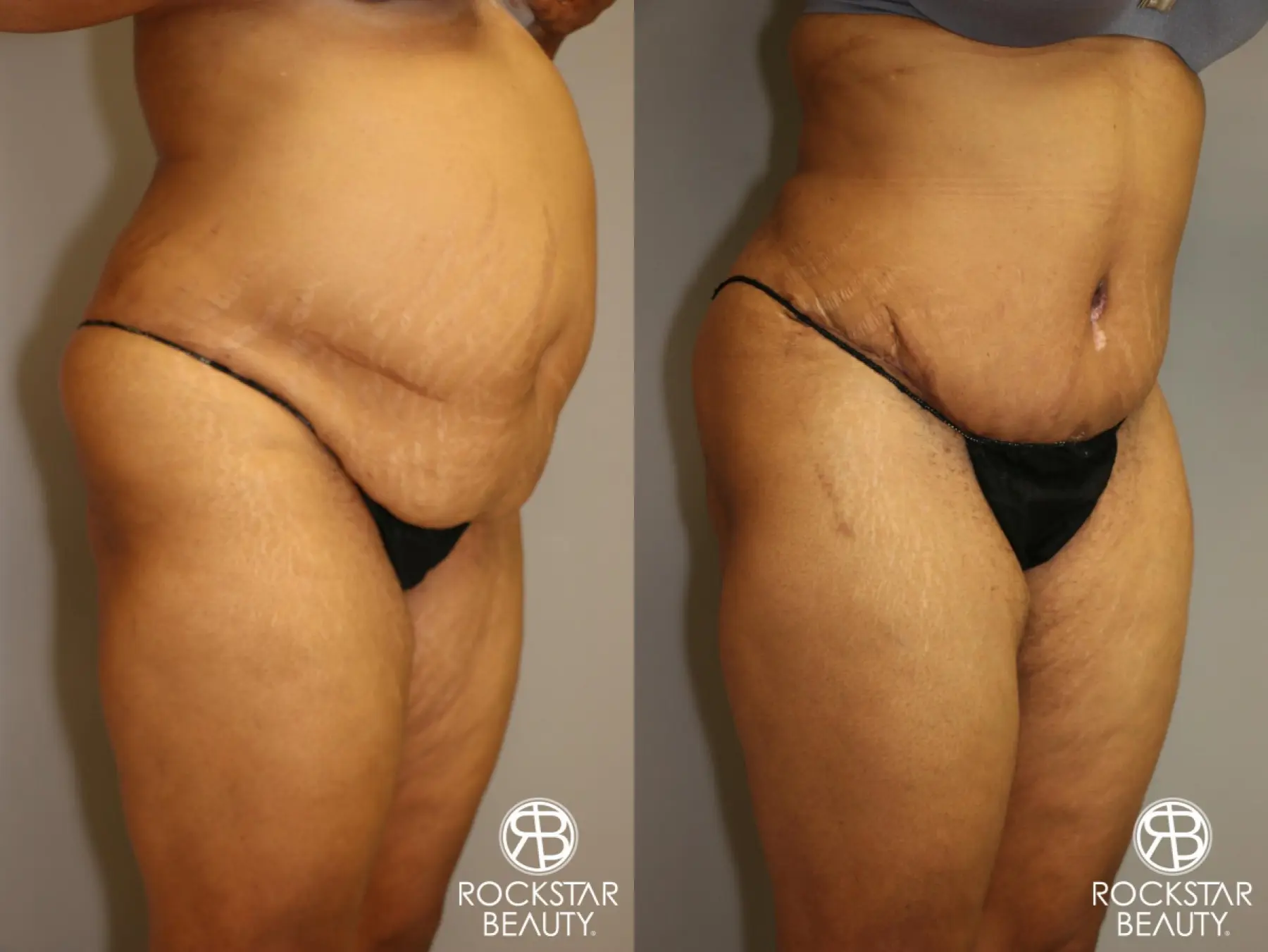 Tummy Tuck: Patient 3 - Before and After 2