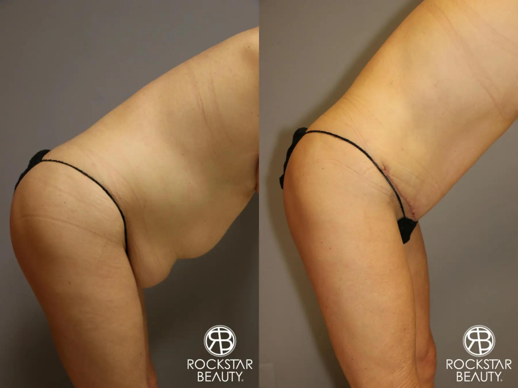 Tummy Tuck: Patient 1 - Before and After 4