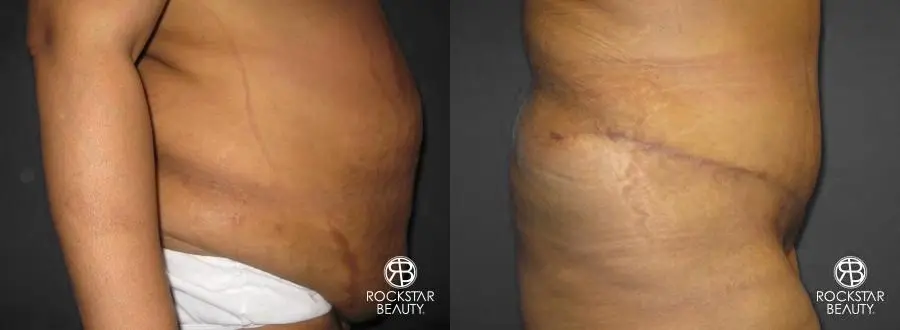 Tummy Tuck: Patient 8 - Before and After 2