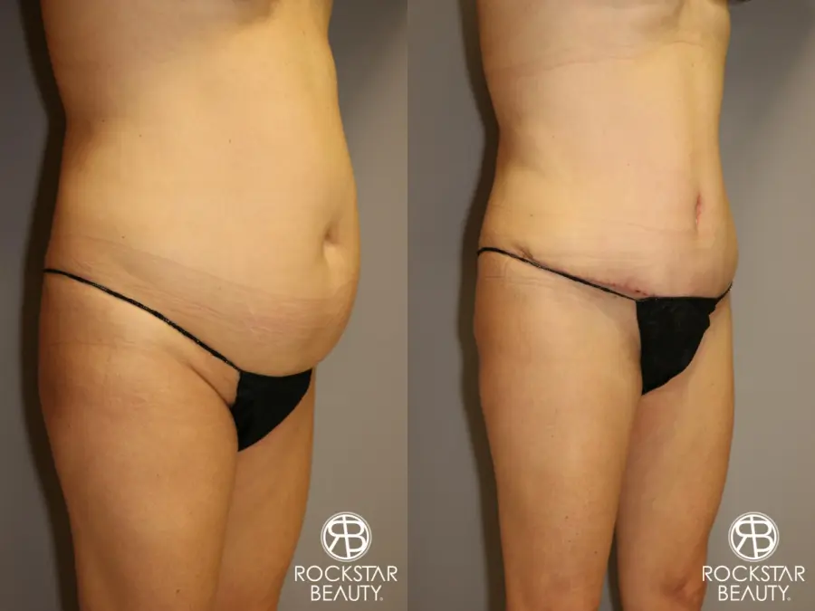 Tummy Tuck: Patient 1 - Before and After 2