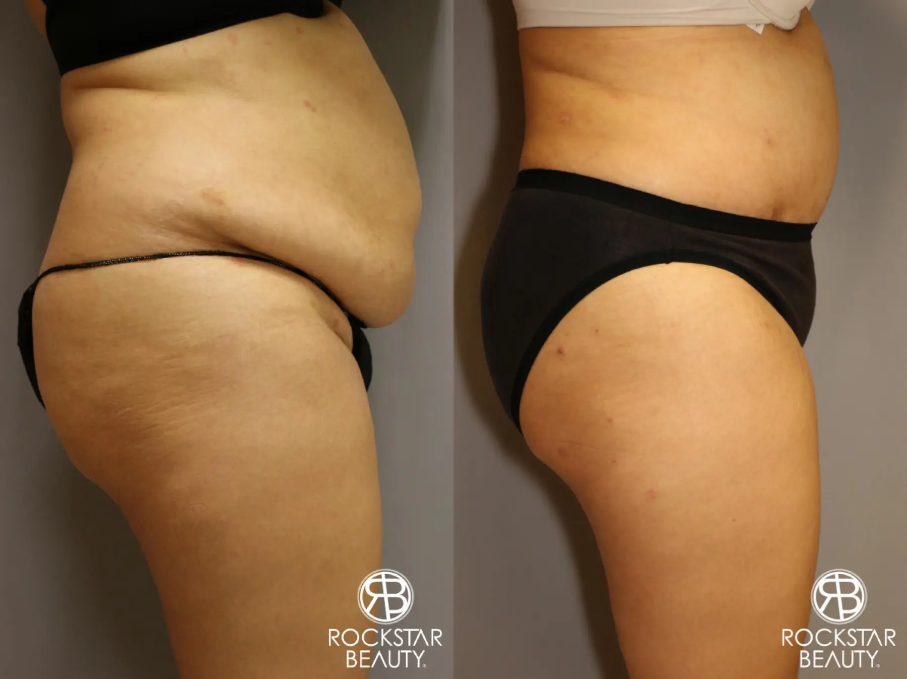 Tummy Tuck: Patient 2 - Before and After 3