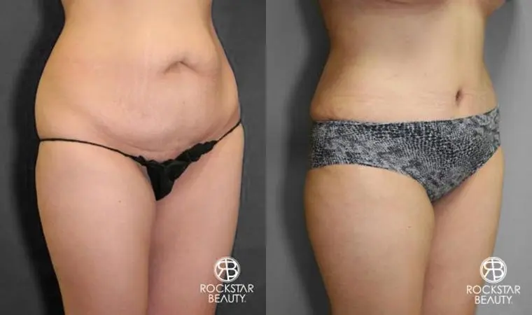 Tummy Tuck: Patient 10 - Before and After 2