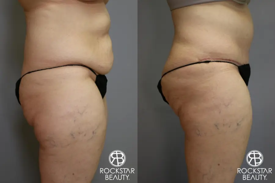 Tummy Tuck: Patient 4 - Before and After 3