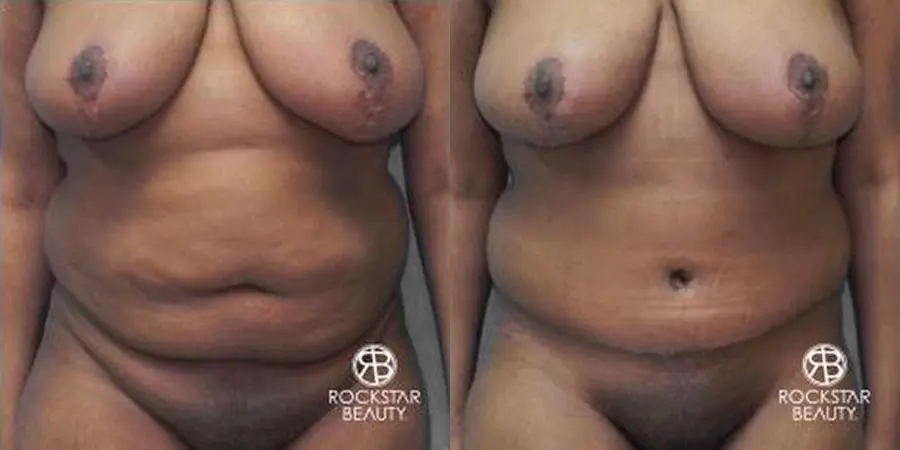 Tummy Tuck: Patient 9 - Before and After  