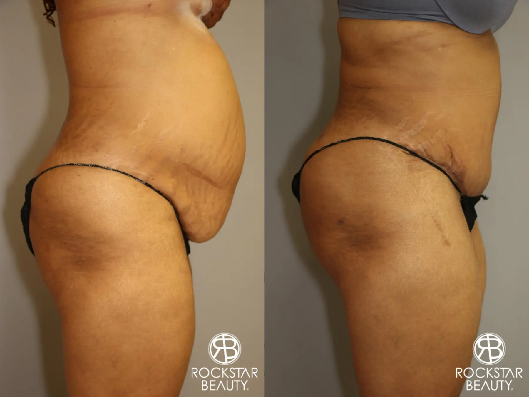 Tummy Tuck: Patient 3 - Before and After 3