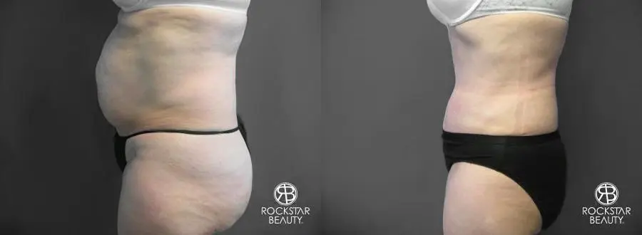 Tummy Tuck: Patient 6 - Before and After 4