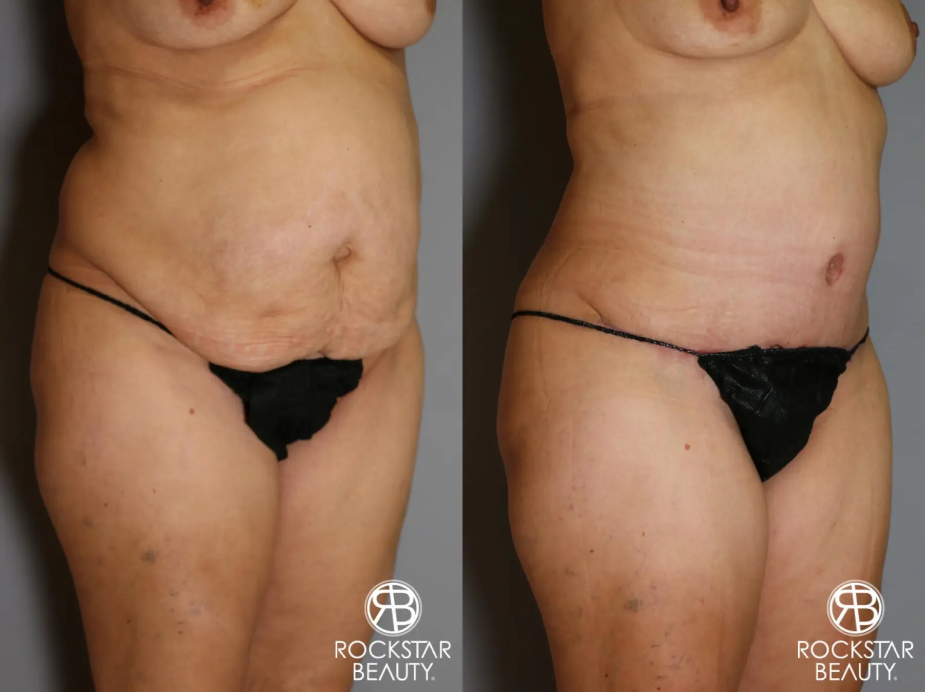 Tummy Tuck: Patient 13 - Before and After 2