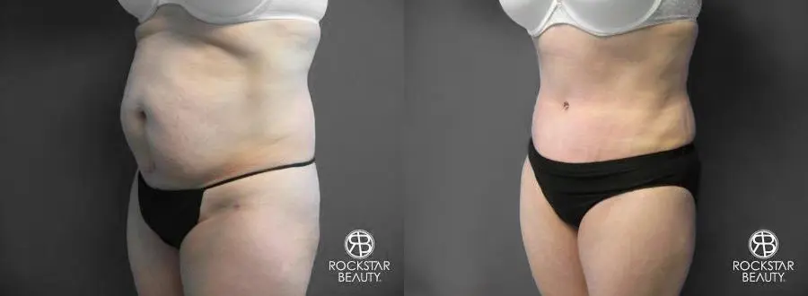 Tummy Tuck: Patient 6 - Before and After 3