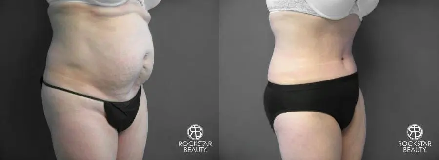 Tummy Tuck: Patient 6 - Before and After 2