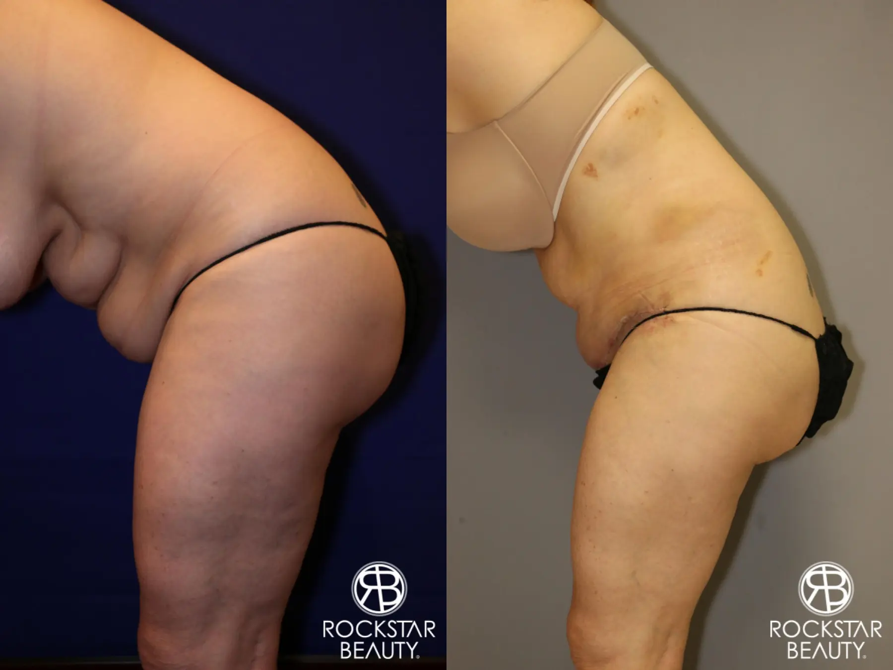 Tummy Tuck: Patient 12 - Before and After 4