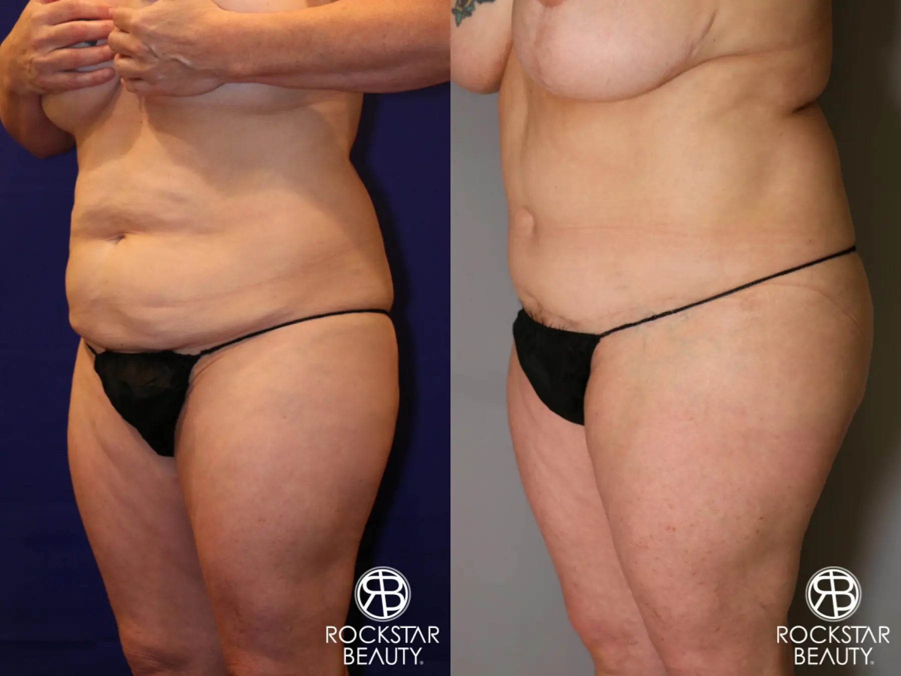 Tummy Tuck: Patient 12 - Before and After 2