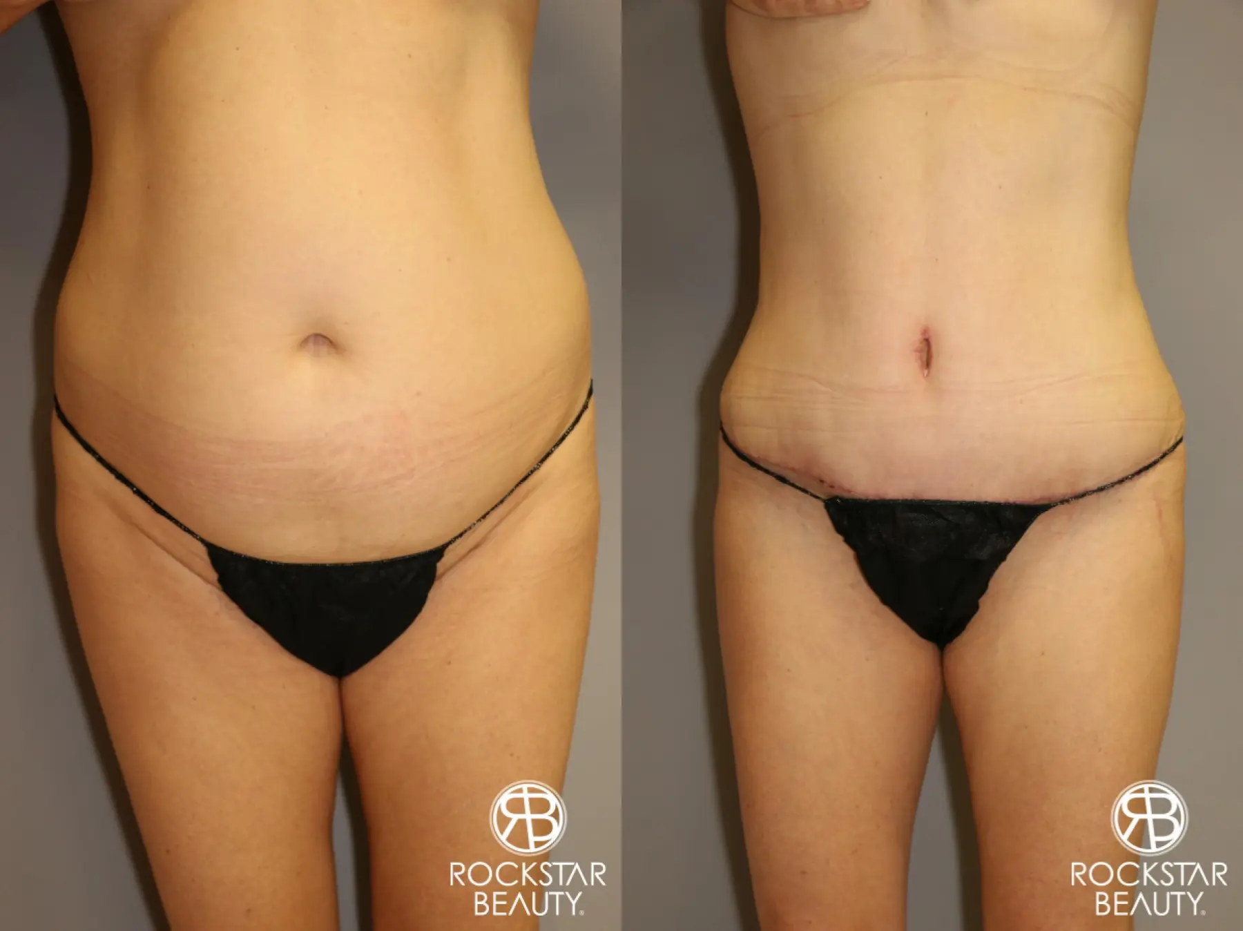 Tummy Tuck: Patient 1 - Before and After  