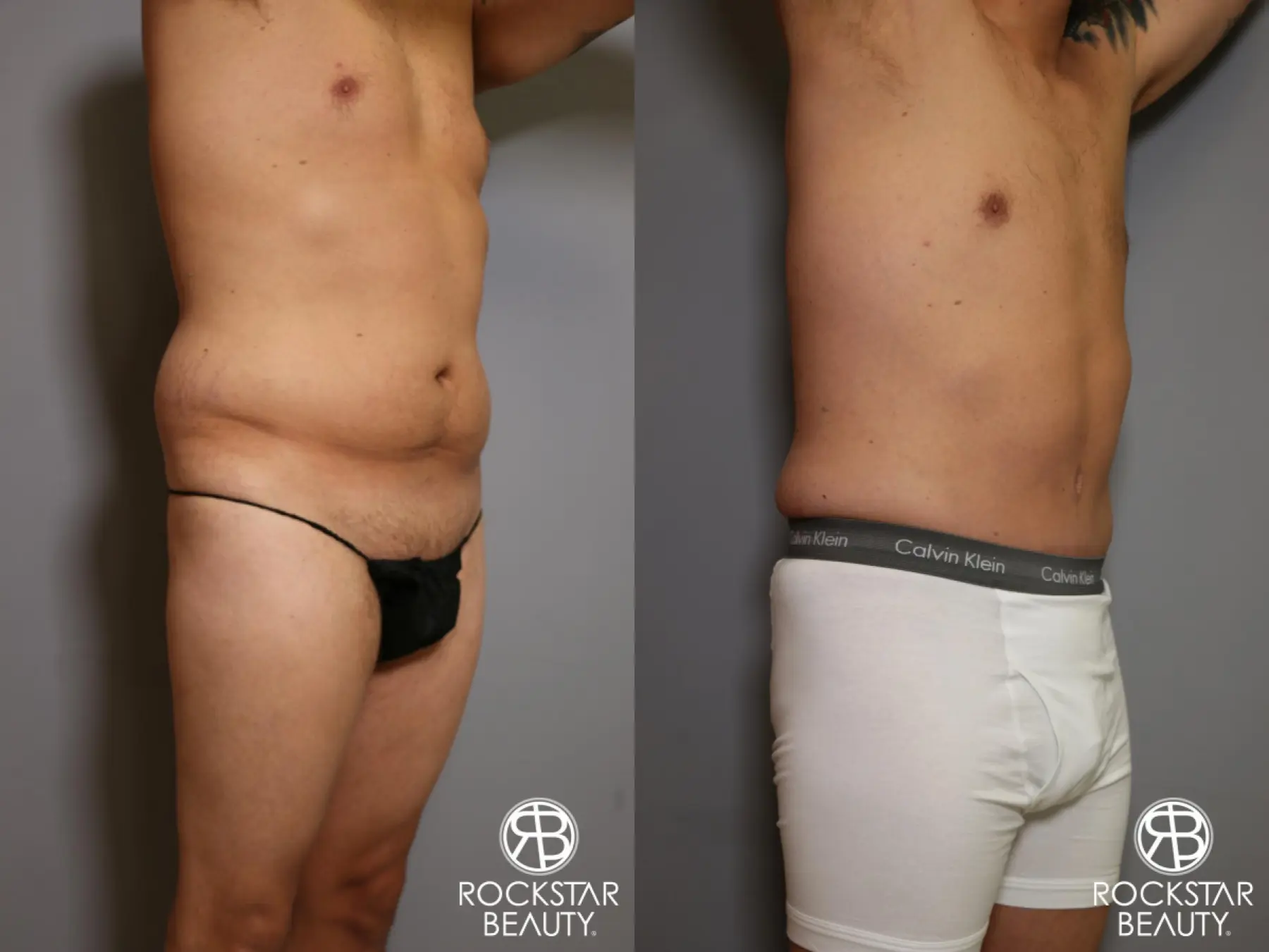 Tummy Tuck: Patient 5 - Before and After 3