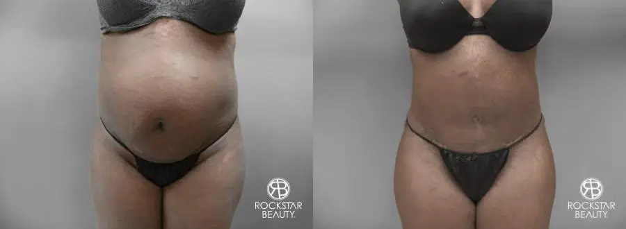 Tummy Tuck: Patient 7 - Before and After  