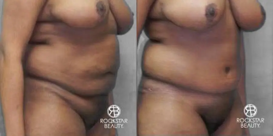 Tummy Tuck: Patient 9 - Before and After 2