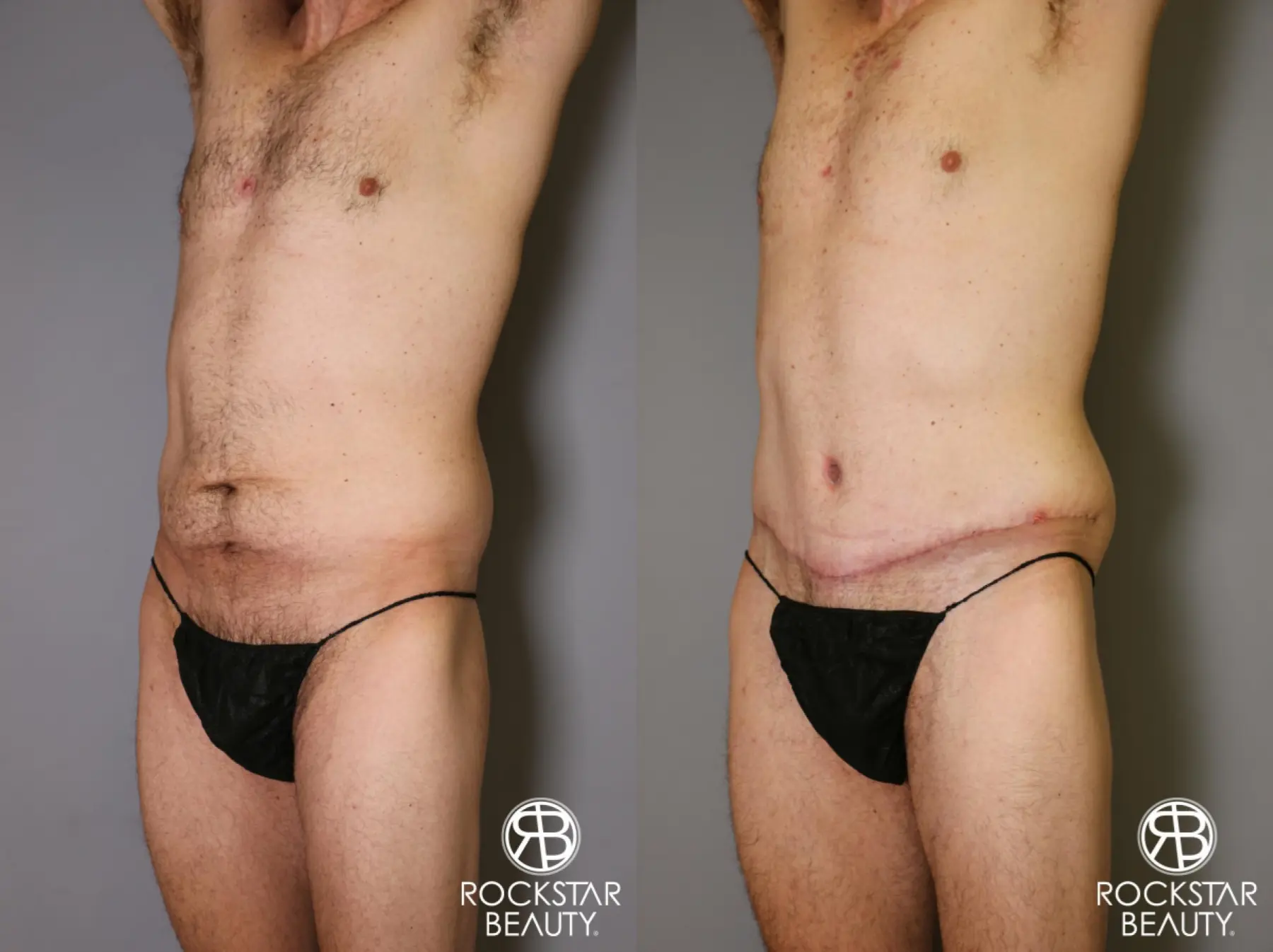 Tummy Tuck: Patient 11 - Before and After 4