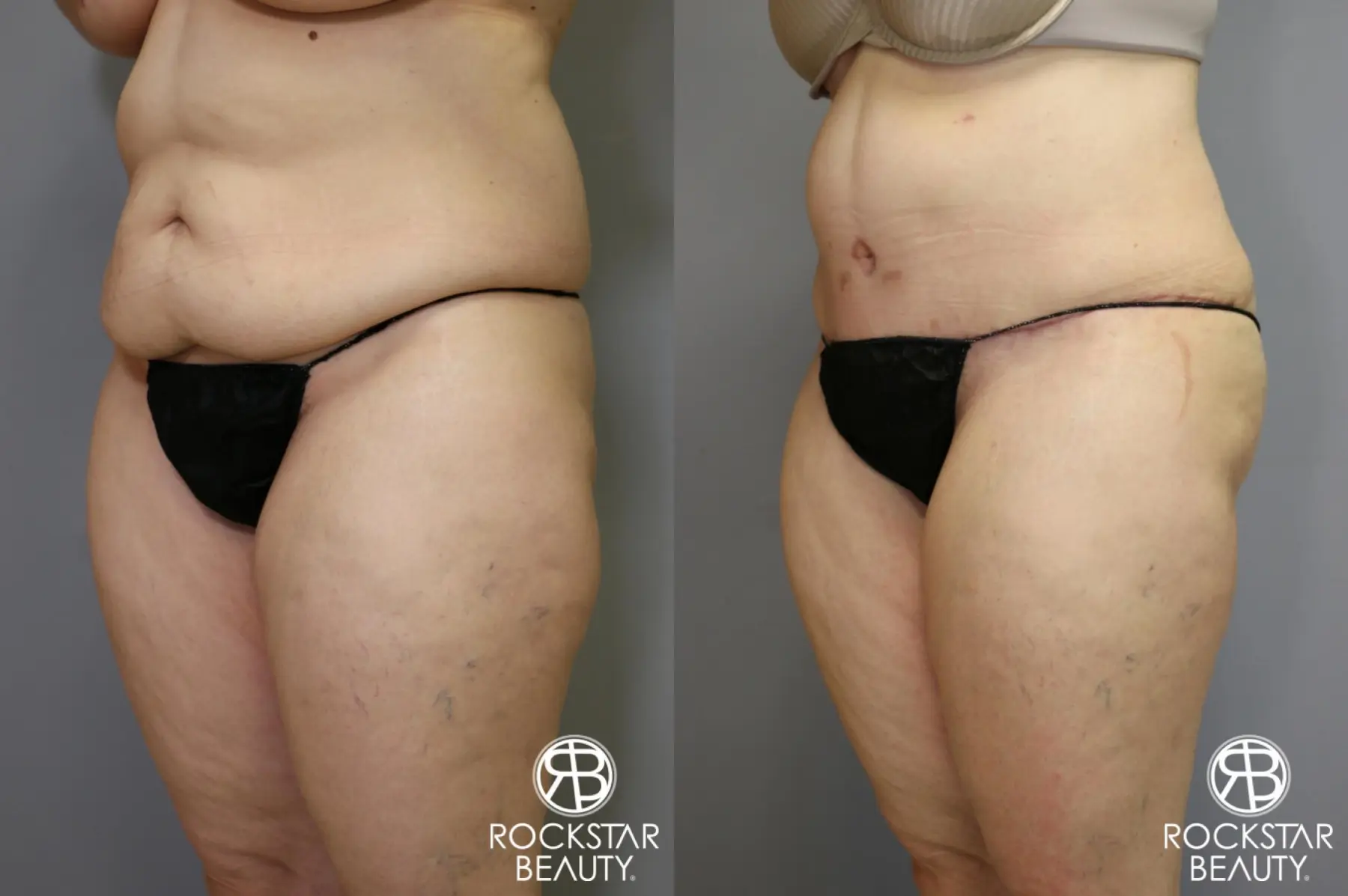 Tummy Tuck: Patient 4 - Before and After 4