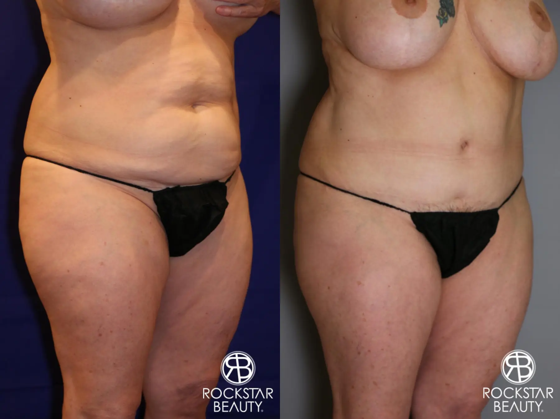 Tummy Tuck: Patient 12 - Before and After 3