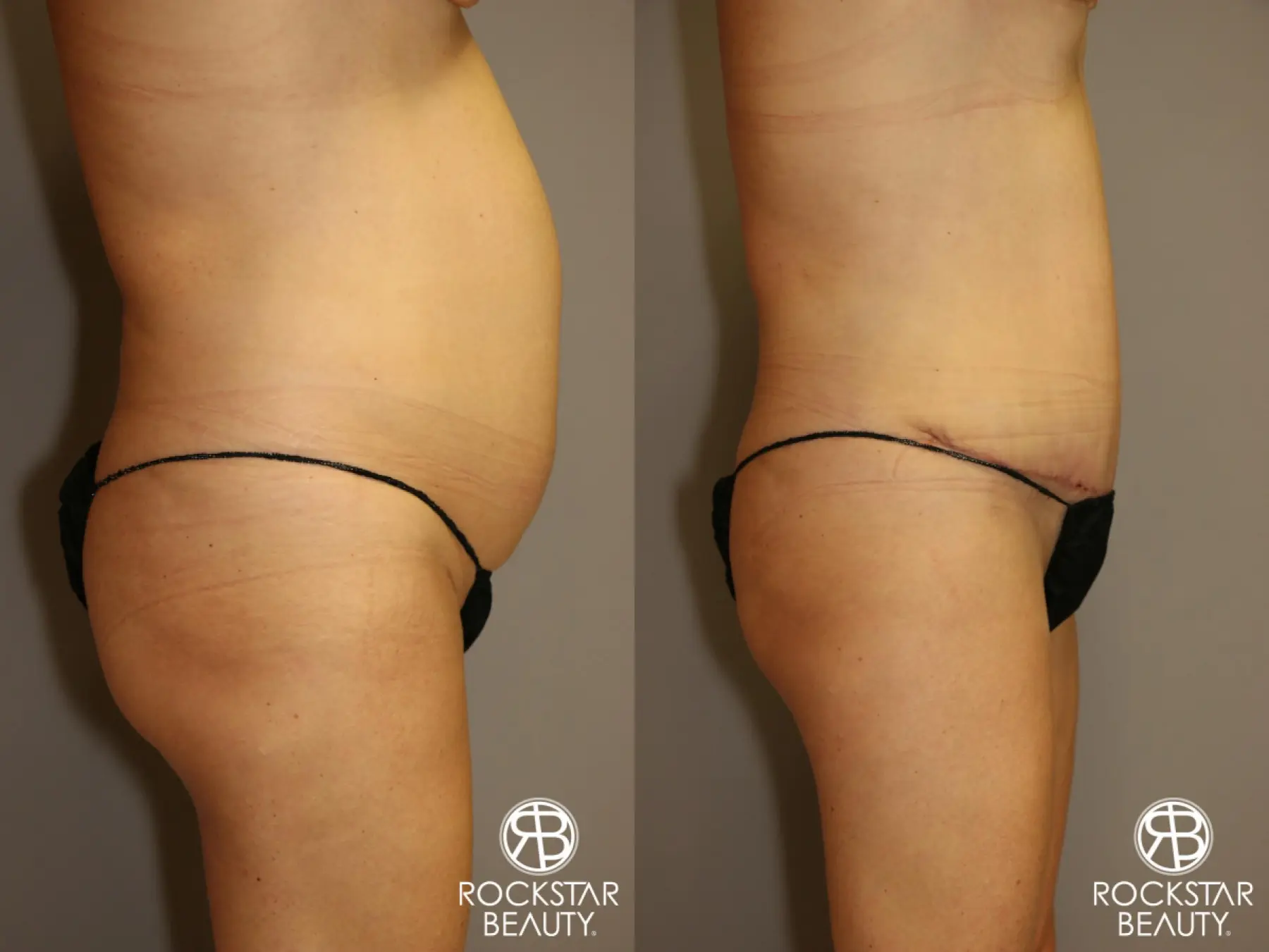 Tummy Tuck: Patient 1 - Before and After 3