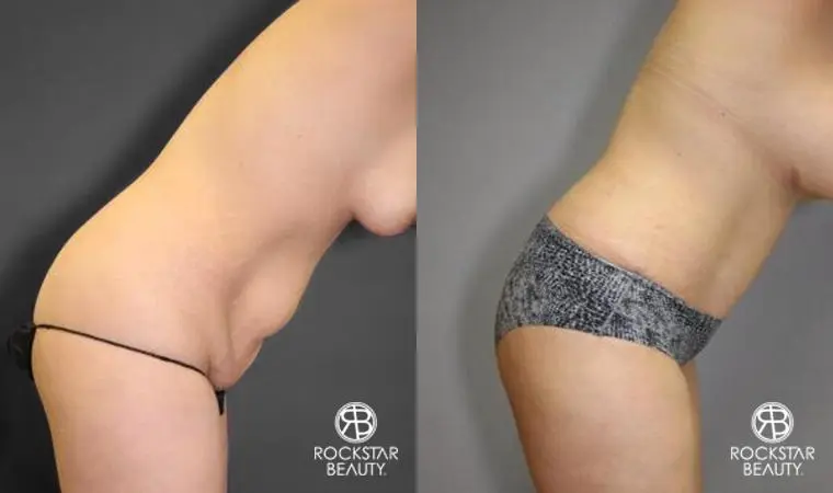 Tummy Tuck: Patient 10 - Before and After 4