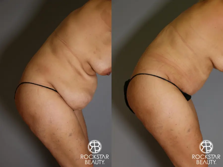 Tummy Tuck: Patient 13 - Before and After 5