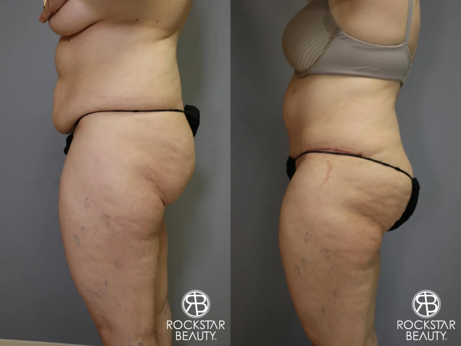 Tummy Tuck: Patient 4 - Before and After 5